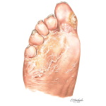 Dry, Cracked Skin In the Diabetic Foot