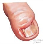 Ingrown Toenail