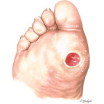 Skin Ulcer In the Diabetic Foot