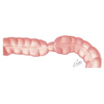 Slowed Contraction of the Colon