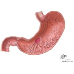 Peptic Ulcer Disease