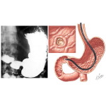 Diagnosing Peptic Ulcers