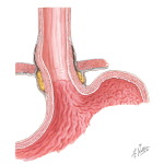 Esophagus