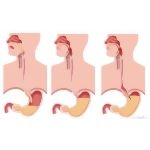 Description of Gastroesophageal Reflux Disease (GERD)