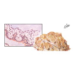 Pseudomyxoma Peitonei