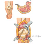 Surgical Approaches to the Elbow