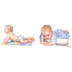 Plagiocephaly: Repositioning