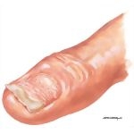 Psoriatic Nail Involvement