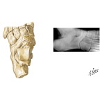 Pediatric Disorders of the Foot