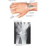 Ganglion of Wrist Kienbock's Disease