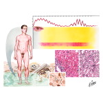 Weil Disease