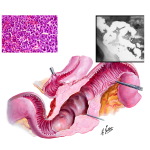 Cancer of the Small Intestine: Lymphomas