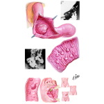 Tumors of the Small Intestine
