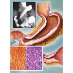 Carcinomas of the Stomach