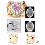Vascular Malformations