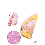 Fibrocystic Disease: Early Changes