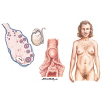 Sertoli-Lydig Cell Tumor