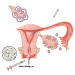 Assisted Reproduction