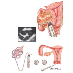 Assisted Reproduction