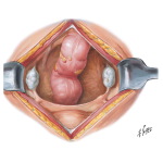 Uterine Anomalies: Uterine Agenesis