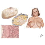 Polycystic Ovarian Disease