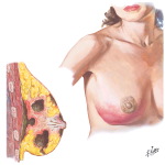 Mastitis (Lactational)