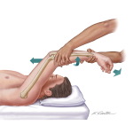 Posterolateral Rotatory Instability