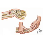 Acute Pediatric Wrist Fractures: Clinical Prediction Rule