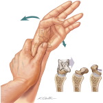 Detecting Carpal Instability