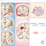 Stroke: Symptoms and Drug Treatmtent
