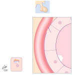 Hypothyroidism: Treatment of Choice