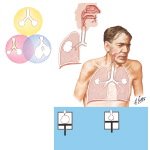 Chronic Obstructive Pulmonary Disease
