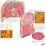 Bacterial Pneumonia