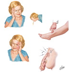 Major Adverse Effects of Combination Oral Contraceptives