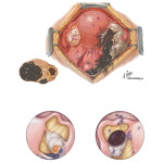 Endometriosis