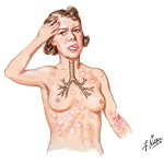 Adverse Effects of Penicillins
