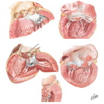 Vancomycin Used for Endocarditis