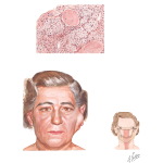 Tumors of the Parotid Gland