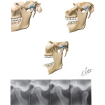 Opening of the Mandible