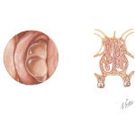 Rhinitis