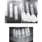 Surgical Procedures: Maxillary Implants