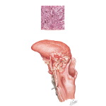 Squamous Cell Carcinoma