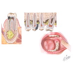 Abscesses