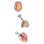 Maxillary Injections: Greater Palatine Nerve Block