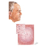 Temporal Arteritis