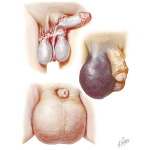 Avulsion Edema, Hematoma