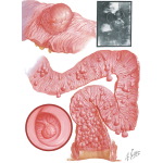 Benign Tumors Of Colon - Multiple Polyposis