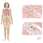 Sarcoidosis