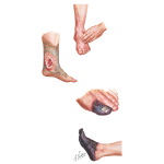 Diabetic Neuropathy