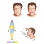 Myasthenia